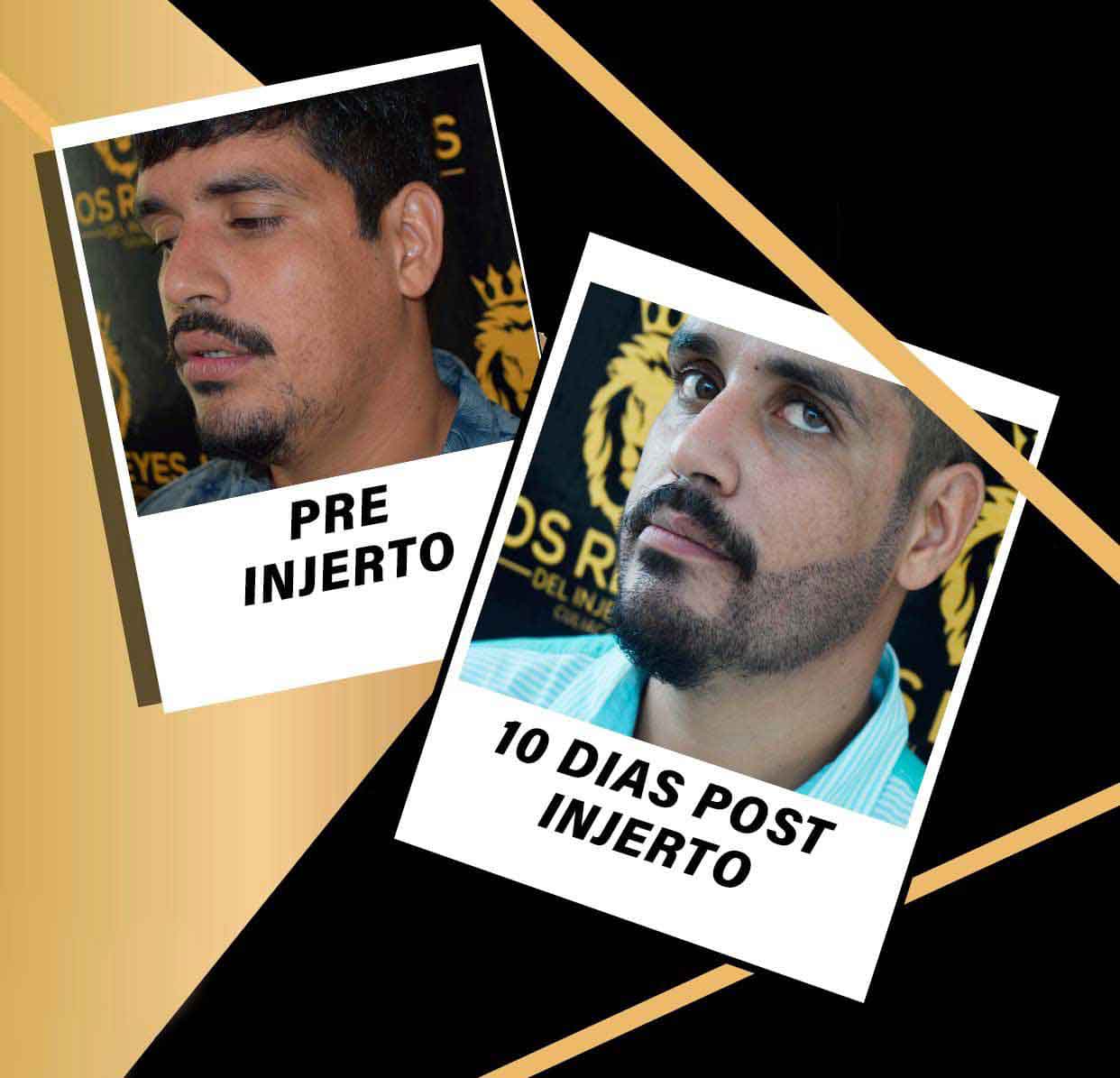 jaimico-los-toys-injerto-cabello