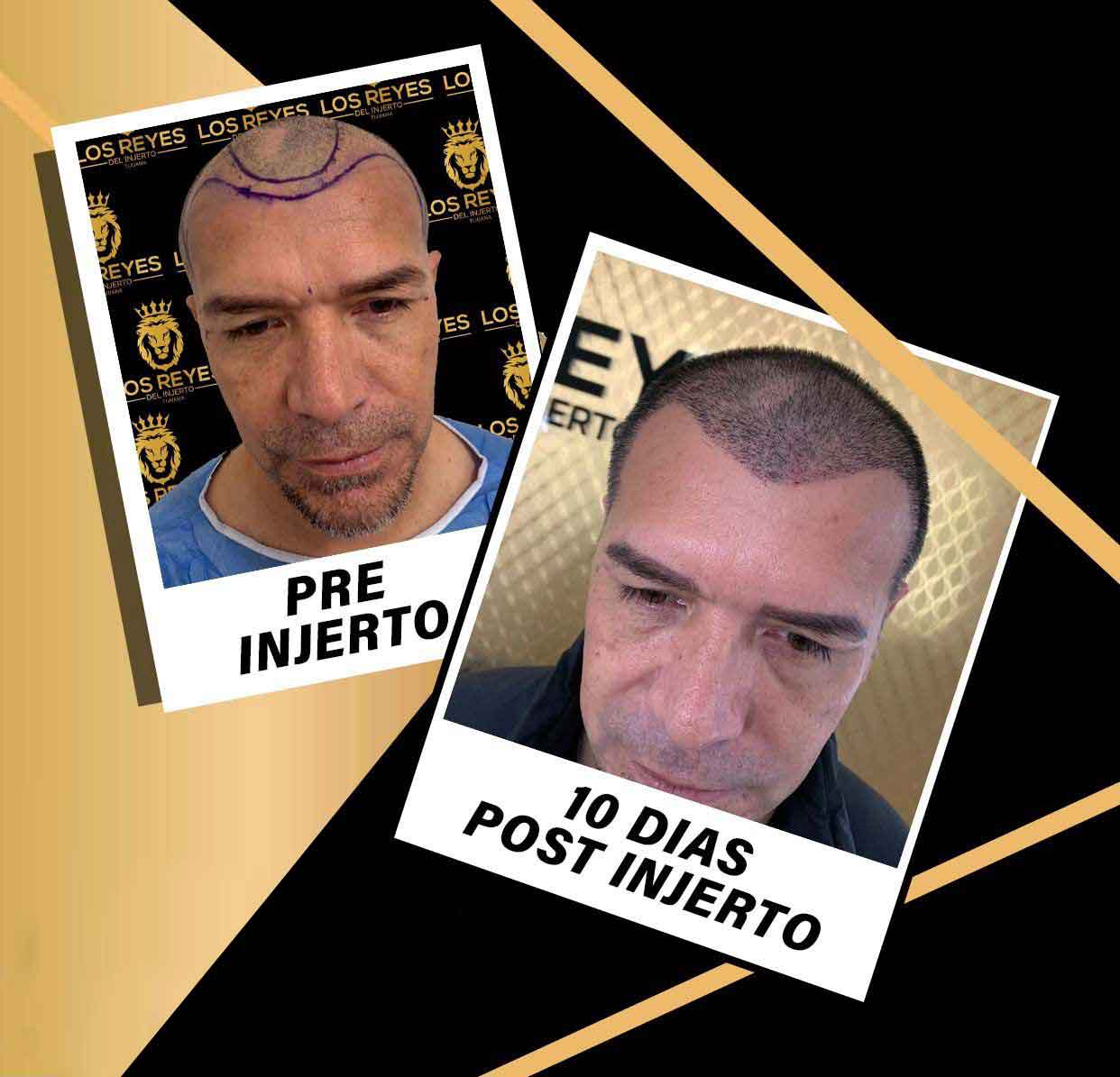 jared-borguetti-injerto-cabello